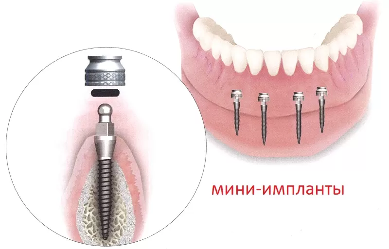 Базальная имплантация зубов Томск Садовый космодент отзывы москва